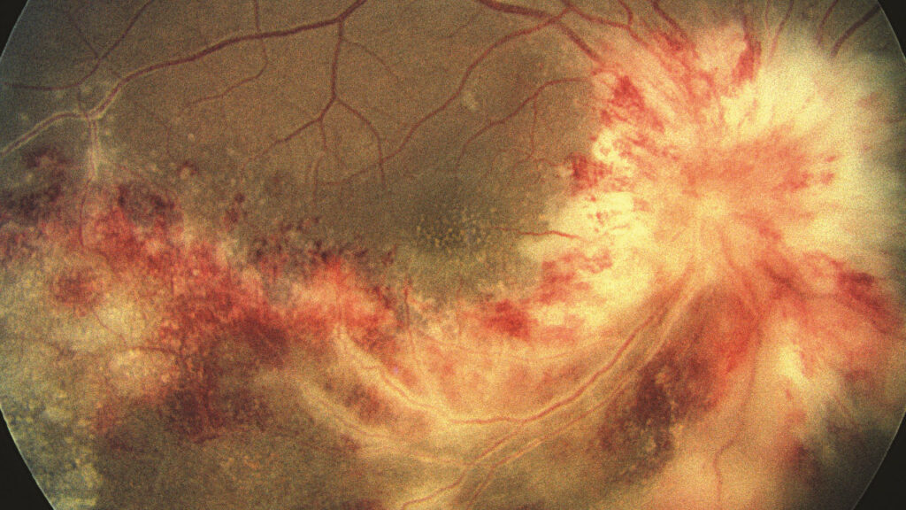 Retina Hastalıklarında Erken Teşhisin Önemi